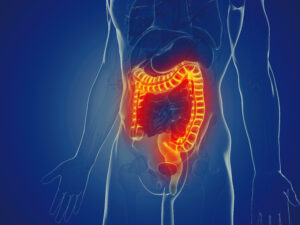 Graphic of a man with Ulcerative Colitis